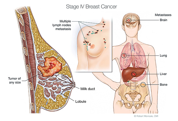 Breast Cancer Myths vs. Facts Part Two