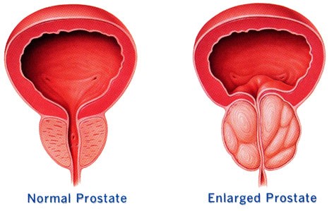 Exploring Treatment Options for Prostate Cancer: A Comprehensive Overview